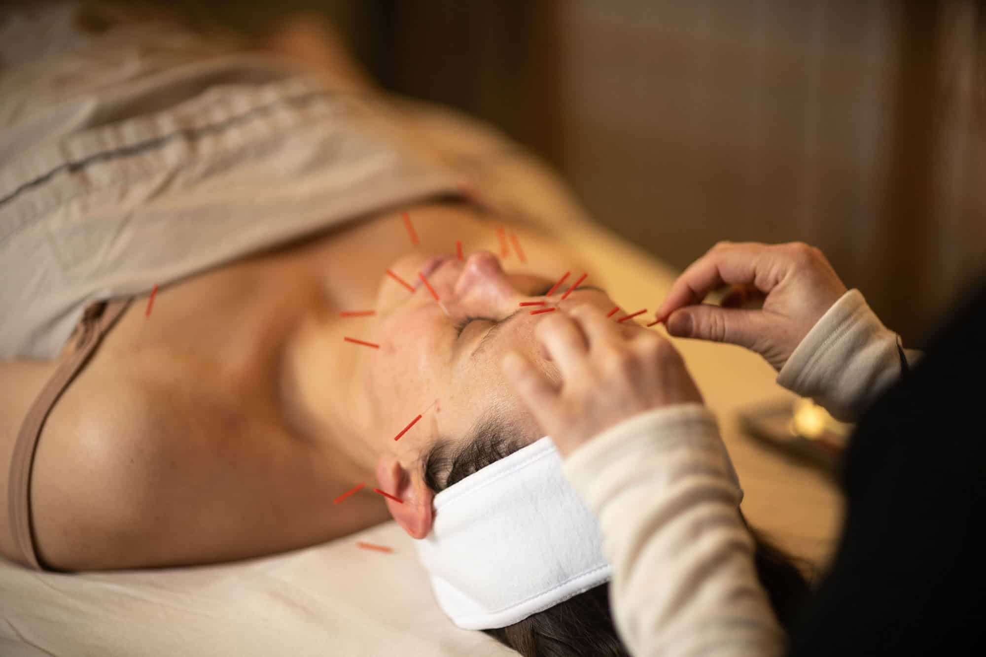 Cosmetic Acupuncture